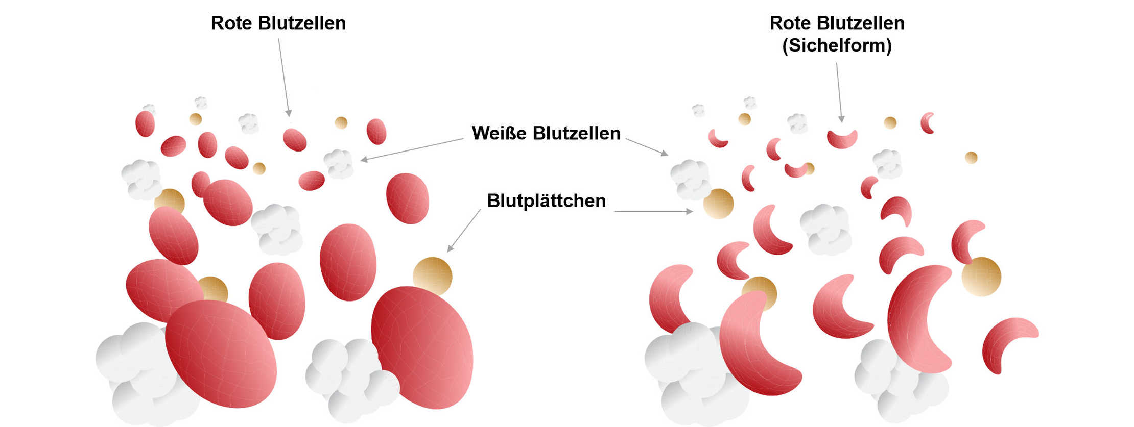 Blut bei Sichelzellkrankheit Blut bei Sichelzellkrankheit