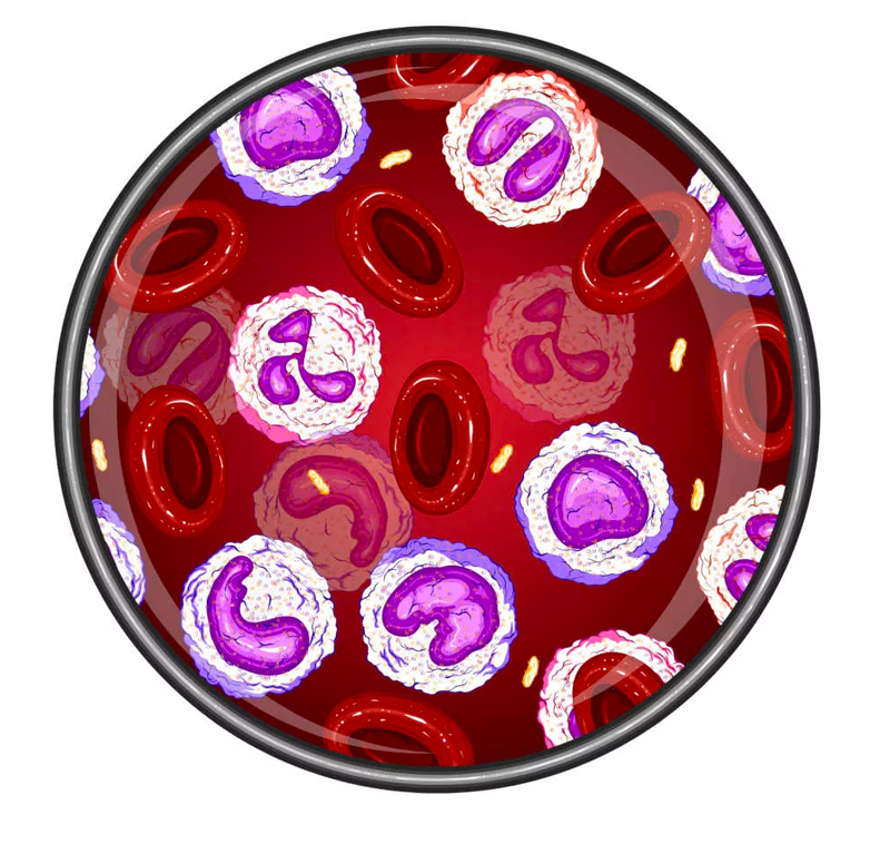 Blutbild bei Leukämie Blutbild bei Leukämie