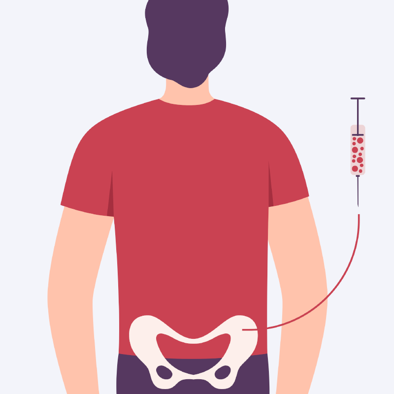 Abbildung Knochenmarkpunktion