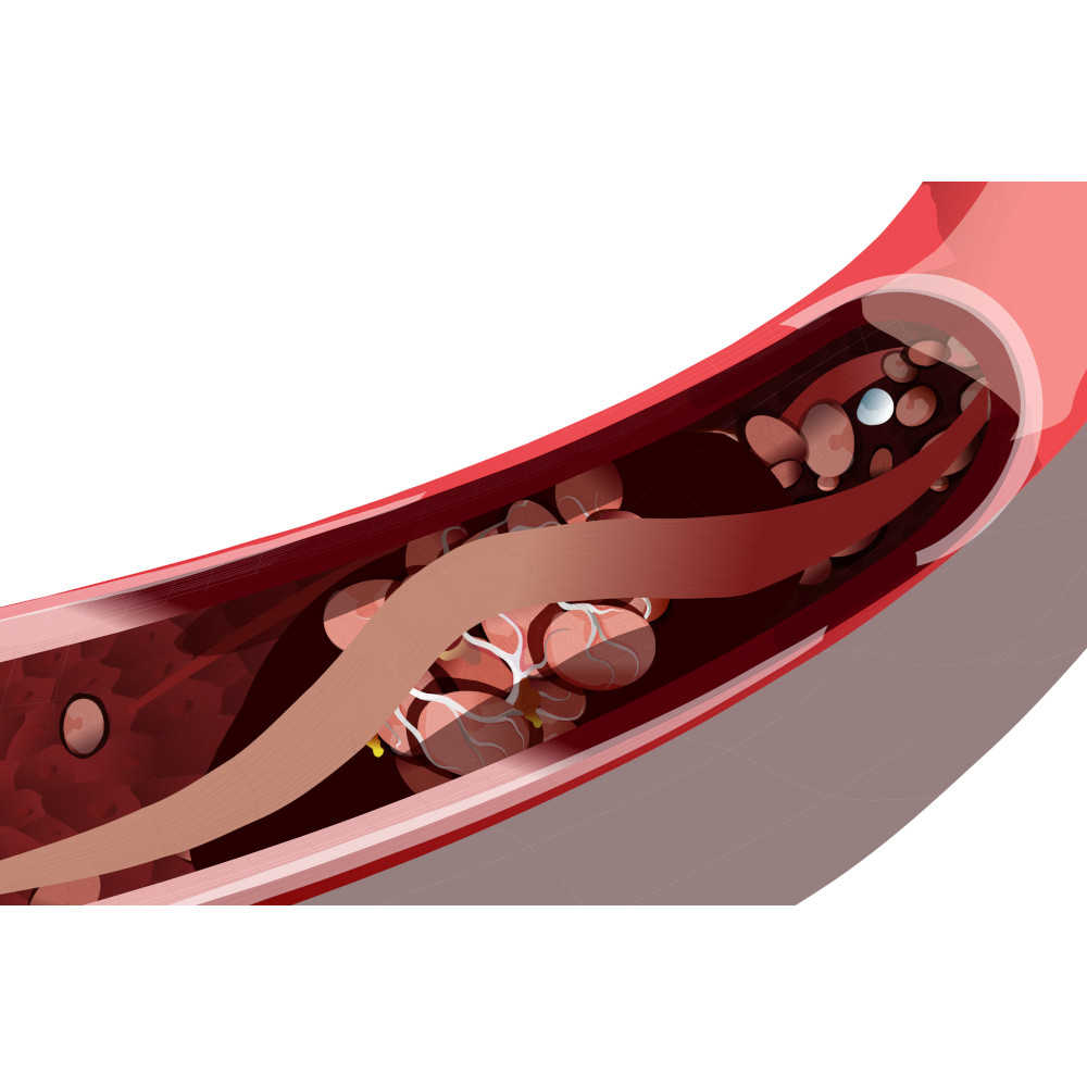 Blutgefäß Polycytaemia vera